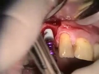 How To Prepare Alveolar Bone For Implantation After Tooth Extraction
