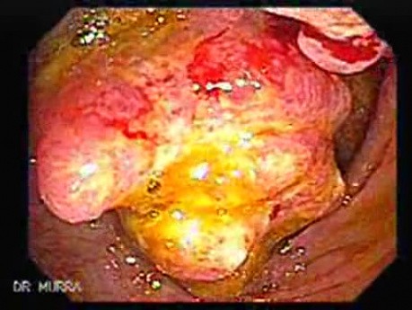 Cecum Adenocarcinoma (1 of 2)