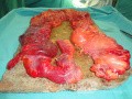 Multiple Rectal Ulcers (72 of 110)