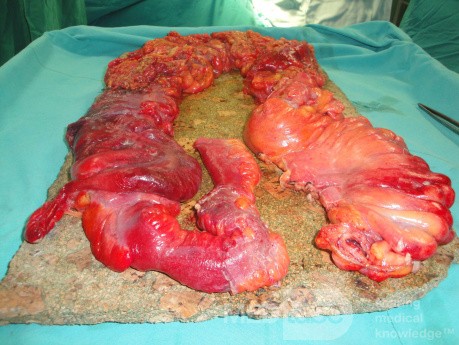 Multiple Rectal Ulcers (72 of 110)