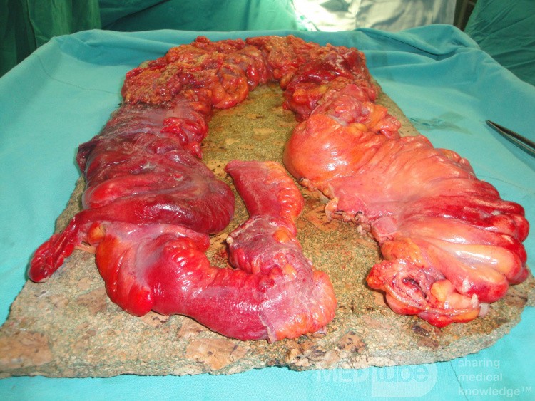 Multiple Rectal Ulcers (72 of 110)
