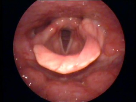 Aryepiglottic Cyst - Moderate Size