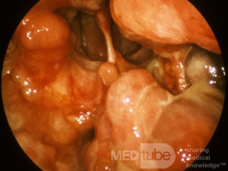Wegener's Granulomatosis