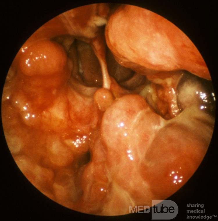 Wegener's Granulomatosis