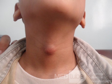 Thyroglossal Cyst