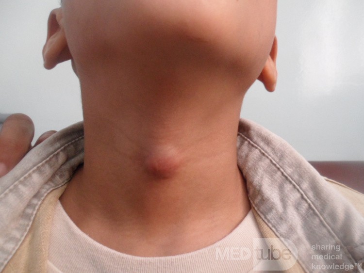 Thyroglossal Cyst