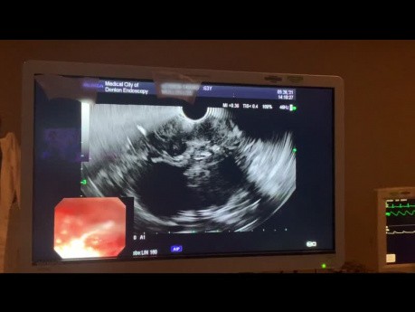 Refractory Gastric Ulcer Presenting Diagnostic Challenge Finally Diagnosed as NHL 