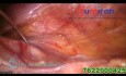 Cerclage in a 22 Wks of Pregnancy