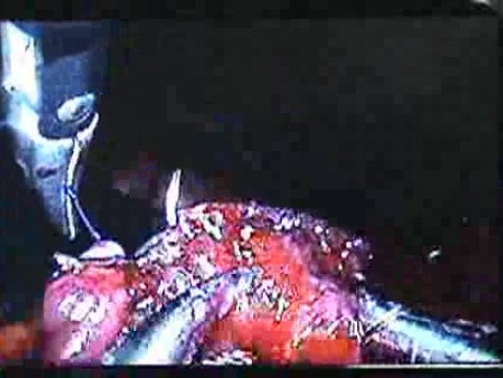 Jejunal Gastrointestinal Stromal tumor (GIST) (59 of 86)