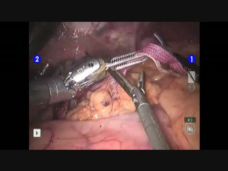 Robot Assisted Hiatoplasty after previous Sleeve Gastrectomy  