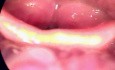Laryngeal Tuberculosis - Endoscopic View