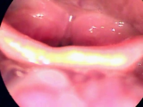 Laryngeal Tuberculosis - Endoscopic View