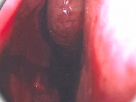 Septoplasty - Endoscopy - Updated