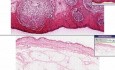 Furuncle (abscess) - Histopathology - Skin