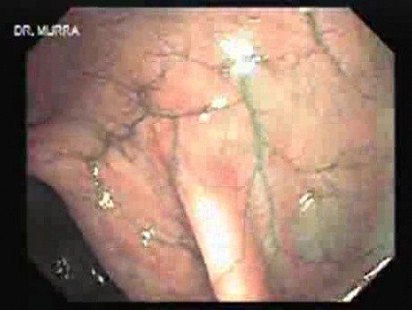 Narrow Band Imaging (NBI) (3 of 3)