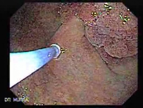 Multilobulated Gastric Polyp (5 of 20)