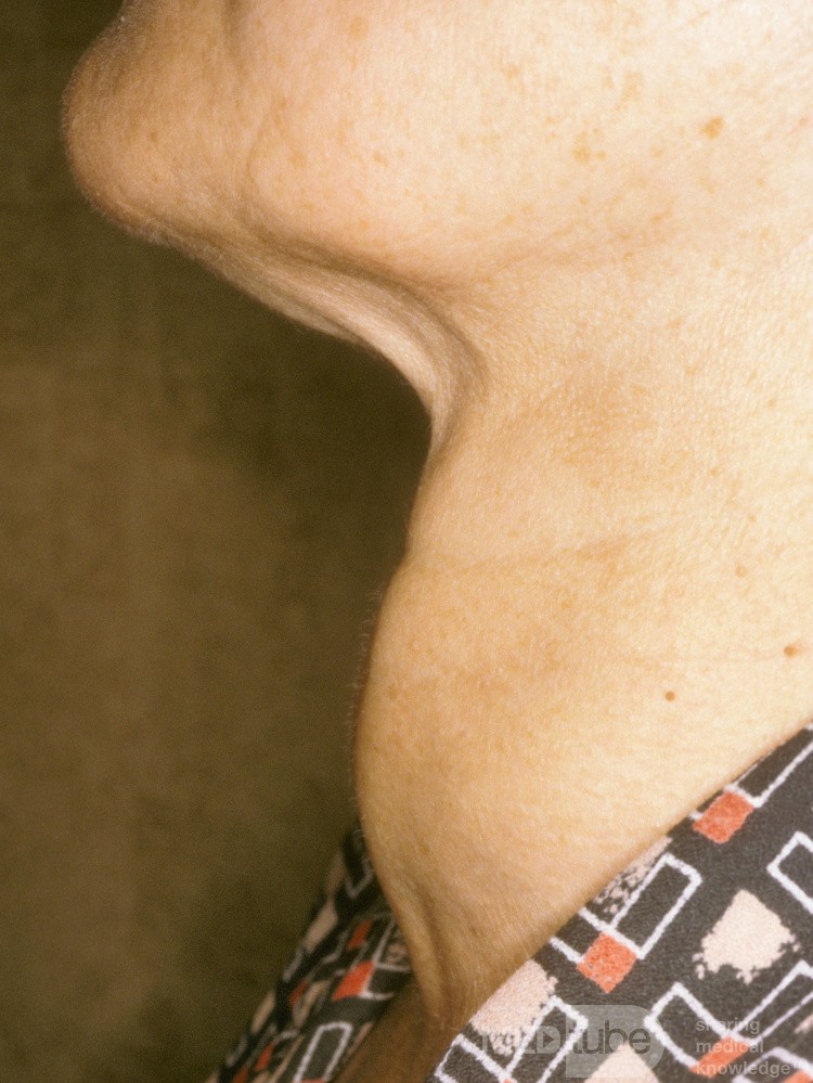 Large Thryoid Goiter [lateral view]