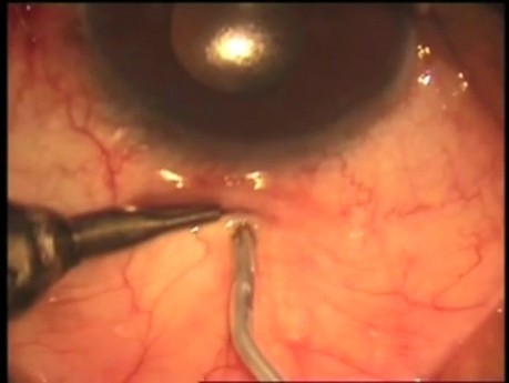TCTCF technique