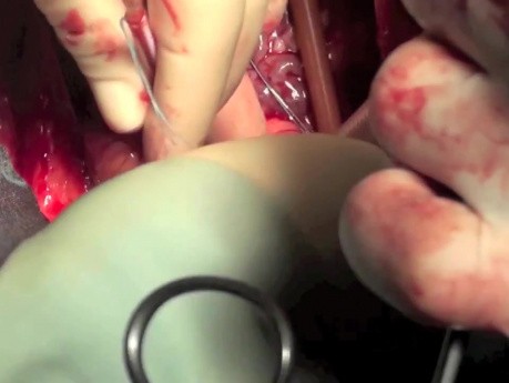 Cannulation