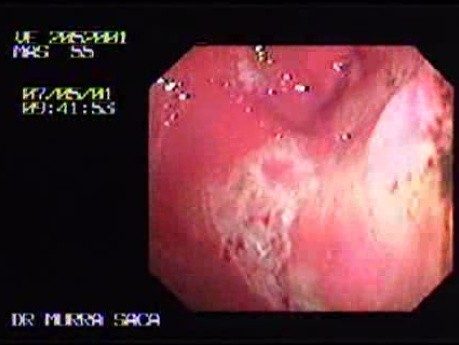 Gastric Cancer