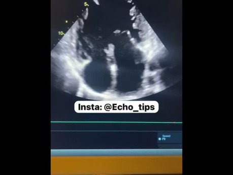 Physiologically Single Ventricle