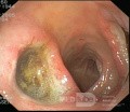 Duodenal Kissing Ulcers