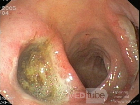 Duodenal Kissing Ulcers