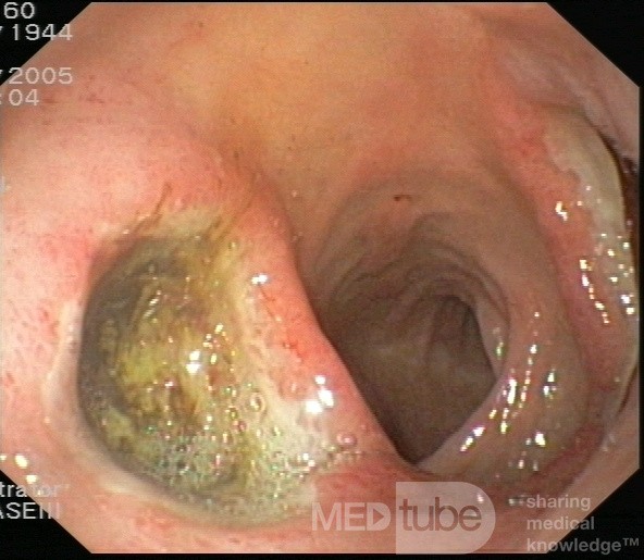 Duodenal Kissing Ulcers