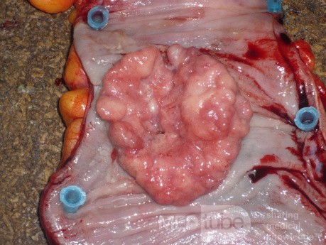 Colon Adenocarcinoma, Villous Adenocarcinoma (11 of 12)