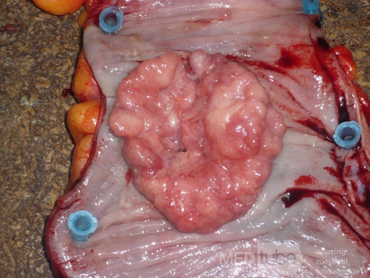 Colon Adenocarcinoma, Villous Adenocarcinoma (11 of 12)