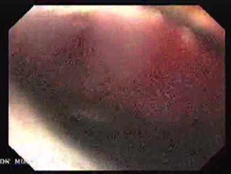 Endoscopic Variceal Ligation - Scars and Varices After Ligation
