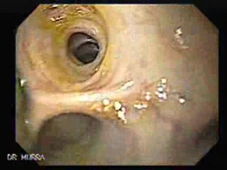Choledocoduodenostomy and The Sump Syndrome (5 of 10)