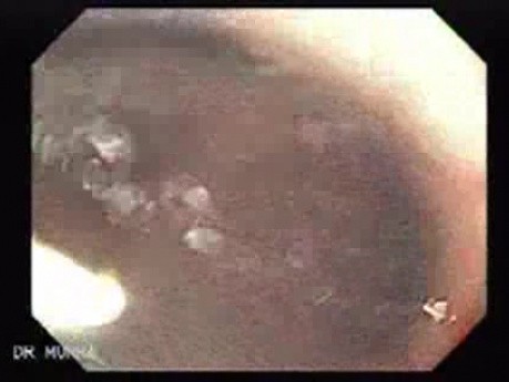 Multiple Gastric Angiodysplasia (8 of 17)
