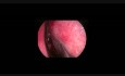 Endoscopic Ethmoidectomy
