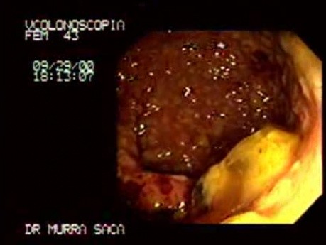 Pseudomembranous Colitis