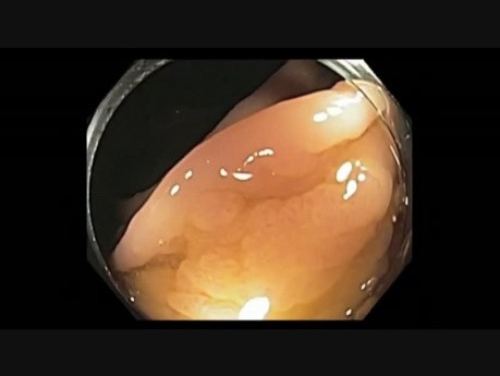 Colonoscopy Channel Quiz 3