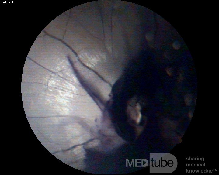 Traumatic Optic Neuropathy