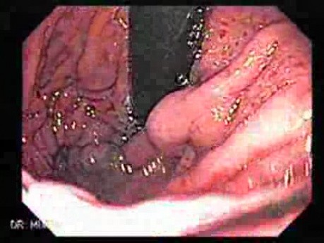 Large Gastric Varices (3 of 4)