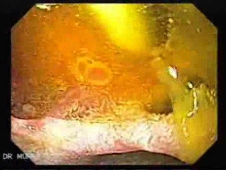 Choledocoduodenostomy (1 of 3)