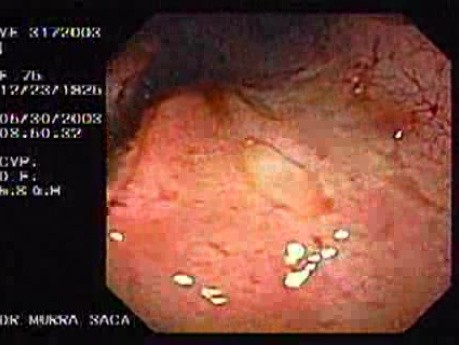 Upper Gastrointestinal Bleeding (3 of 15)