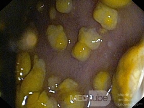 Endoscopic appearance of the Pseudomembranous colitis