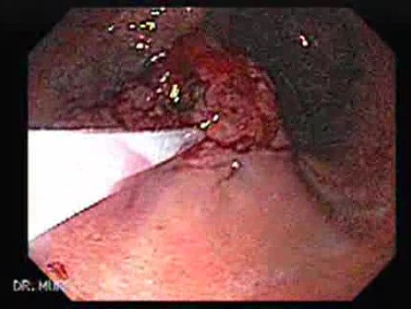 Gastrointestinal Stromal Tumor - GIST (7 of 65)