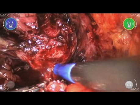 Radical Prostatectomy with Versius - Hubert Oro