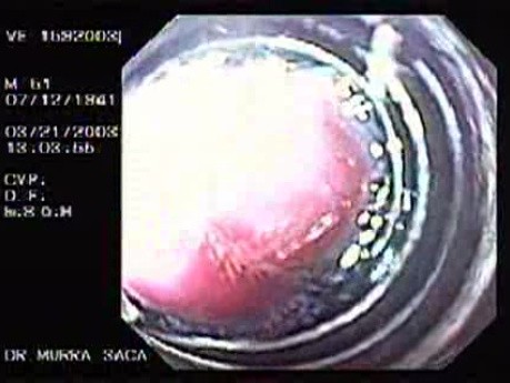 Banding of Esophageal Varices - View Through the Banding Apparatus