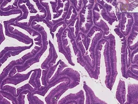 Villous adenoma - Histopathology - Colon
