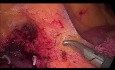 Laparoscopic Right Hemicolectomy for Cecal Cancer, Complete Mesocolic Excision (CME)