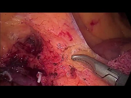 Laparoscopic Right Hemicolectomy for Cecal Cancer, Complete Mesocolic Excision (CME)