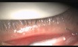 Management of Meibomian Gland Dysfunction with Fugo Blade