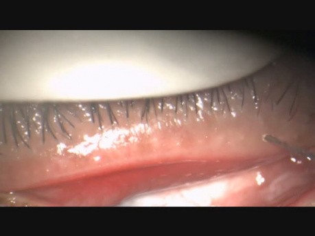Management of Meibomian Gland Dysfunction with Fugo Blade