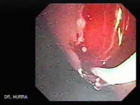 Abdominal Compartment Syndrome due to Malignancy (5 of 10)